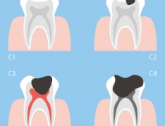 Bệnh Sâu Răng – Nguyên Nhân, Cách Điều Trị & Phòng Ngừa