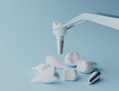 Cấy ghép implant