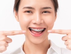 Niềng Răng Thẩm Mỹ