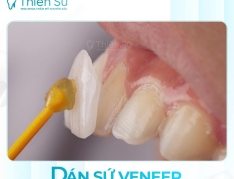 Sứ Veneer